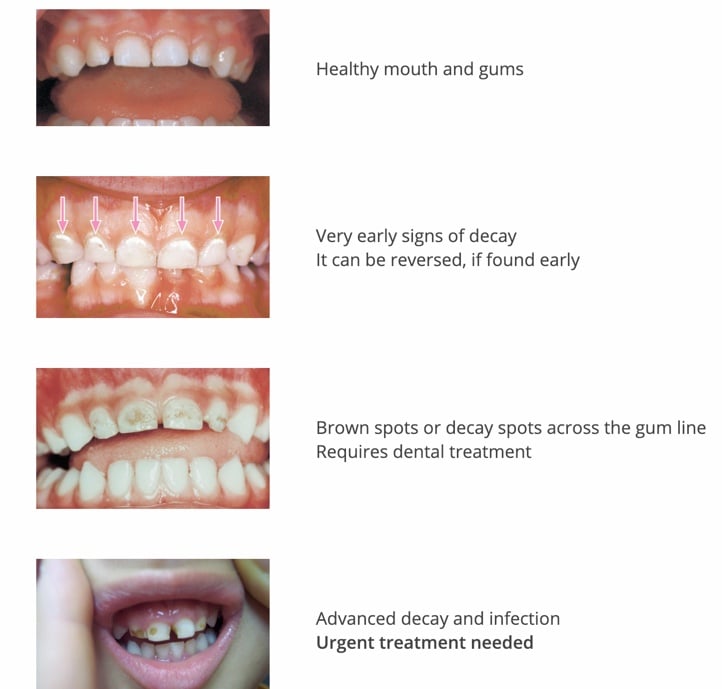 Oral Health & How it Impacts Early Childhood